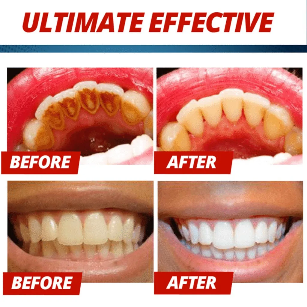 whitening toothpaste white spots on teeth