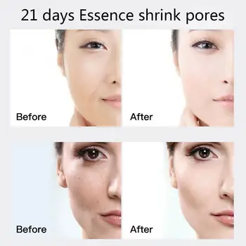 

1/21pcs Face Serum Shrink Pores Hyaluronic Acid Whitening Acne Anti-Aging Cream Care Essence Moisturizing Skin Face Regener I9W9