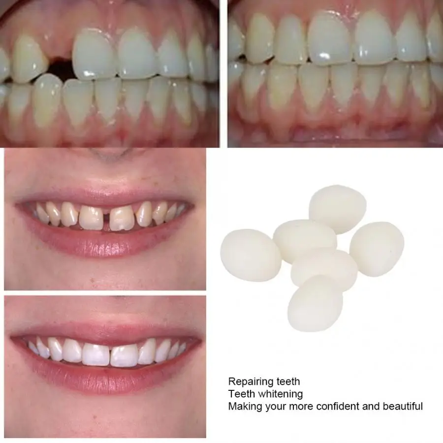 invisalign with fake teeth added