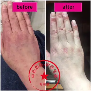Medical plaster Ointment from psoriasis Jinbaiyao Original Psoriasis Dermatitis Eczema Pruritus Skin Problems Cream health
Medical plaster Ointment from psoriasis Jinbaiyao Original Psoriasis Dermatitis Eczema Pruritus Skin Problems Cream health