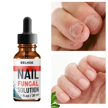 Nail Fungus Treatment Repair Essence for Fingernails and Toenails Repair Solution for Cracked Discolored Fungus Nails 10/20/30ml
Nail Fungus Treatment Repair Essence for Fingernails and Toenails Repair Solution for Cracked Discolored Fungus Nails 10/20/30ml