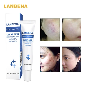 LANBENA Acne Treatment Gel Acne Cleaning Cream Blackhead Remover Acne Spots Face Acne Scars Skin Care Repair Comedone Pimple
LANBENA Acne Treatment Gel Acne Cleaning Cream Blackhead Remover Acne Spots Face Acne Scars Skin Care Repair Comedone Pimple