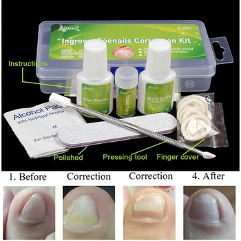 Ingrown Toenails Pedicure Nail Correction Lifter File Fixer Recover Toe Paronychia Podiatry Corrector Foot Care
Ingrown Toenails Pedicure Nail Correction Lifter File Fixer Recover Toe Paronychia Podiatry Corrector Foot Care