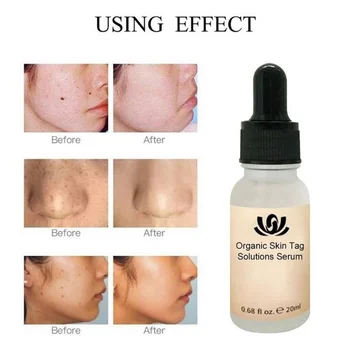 Organic Tags Solutions Serum Mole & Skin Tag Removal Solution Painless Dark Spot Removal Freckle Removal Cream Oil Plaster Face
Organic Tags Solutions Serum Mole & Skin Tag Removal Solution Painless Dark Spot Removal Freckle Removal Cream Oil Plaster Face