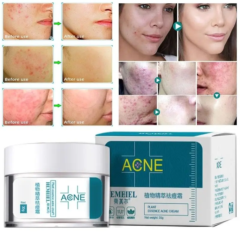 Plant Essence Anti-Acne Cream Moisturizing Oil-Control Remove Blackheads Pimples Face Cream
Plant Essence Anti-Acne Cream Moisturizing Oil-Control Remove Blackheads Pimples Face Cream