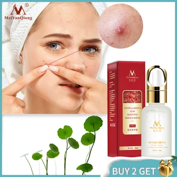 

MeiYanQiong Centella asiatica acne extract removes acne scars, controls oil, and improves facial whitening skin 10ml