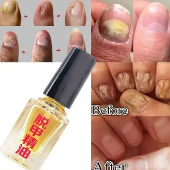 3 Days Effect Fungus Removal Essence Liquid Fungal Nail Foot Infection Bright Onychomycosis Caring Anti Nail Treatment Repa C0Y3
3 Days Effect Fungus Removal Essence Liquid Fungal Nail Foot Infection Bright Onychomycosis Caring Anti Nail Treatment Repa C0Y3
