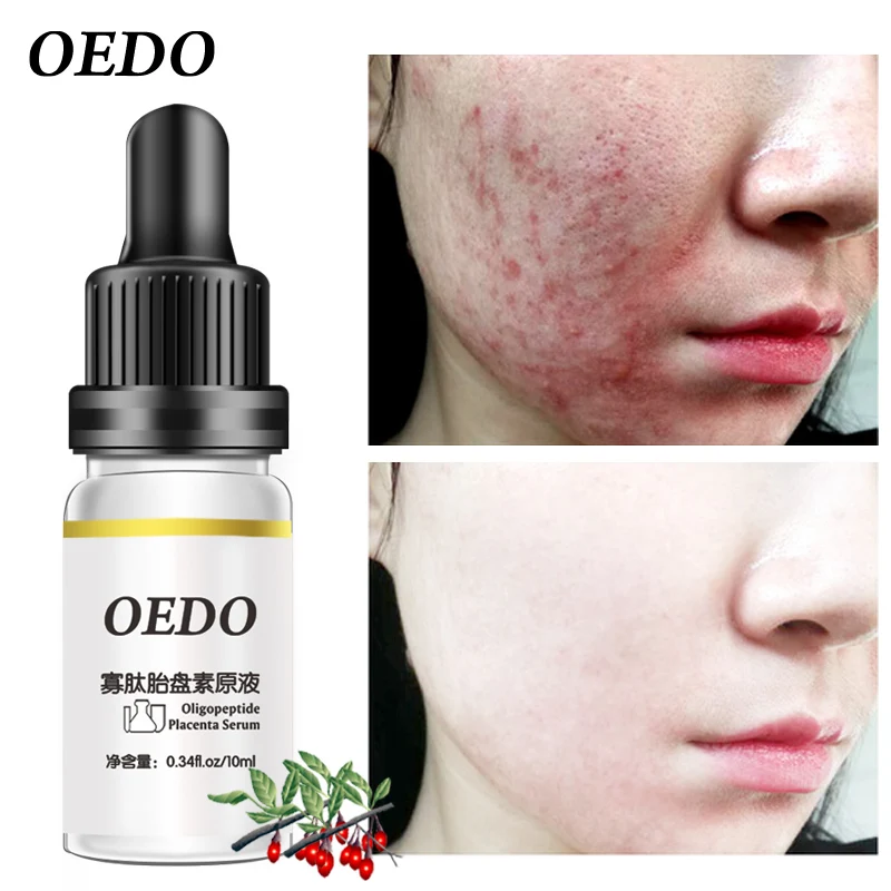 OEDO Acne Treatment Face Serum Oligopeptide Placenta Repair Acnes Pimples Anti-Anging Essence Whitening Moisturizing Skin Care
OEDO Acne Treatment Face Serum Oligopeptide Placenta Repair Acnes Pimples Anti-Anging Essence Whitening Moisturizing Skin Care