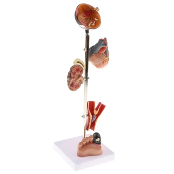 Removable 5 Parts Pathological Diabetes 5 Parts (Eye ball, Heart, ney, Vessel, Foot) Model School Teaching Display
Removable 5 Parts Pathological Diabetes 5 Parts (Eye ball, Heart, ney, Vessel, Foot) Model School Teaching Display