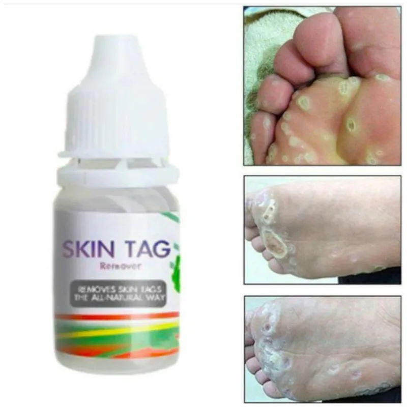 Hot Sale 10ML Body Warts Treatment Cream Skin Tag Remover Foot Corn Removal Plantar Genital Warts Ointment Foot Care Cream
Hot Sale 10ML Body Warts Treatment Cream Skin Tag Remover Foot Corn Removal Plantar Genital Warts Ointment Foot Care Cream