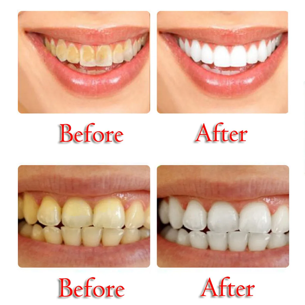 how to whiten your teeth with baking soda and toothpaste