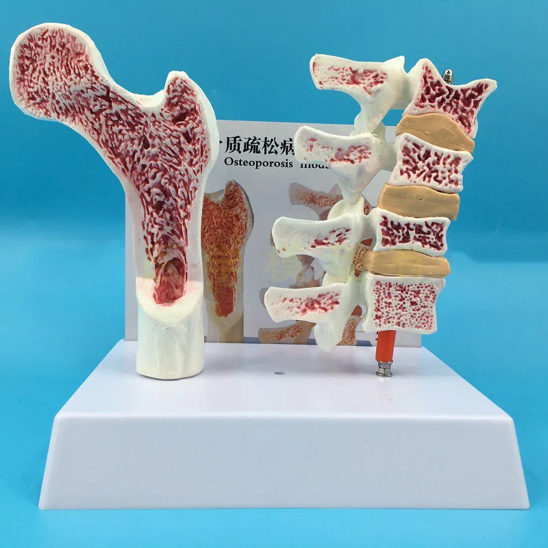 2 parts PVC Human Anatomical Model Osteoporosis Femur Leg Bone Spinal Section Specimen Diseased Lumbar Spine
2 parts PVC Human Anatomical Model Osteoporosis Femur Leg Bone Spinal Section Specimen Diseased Lumbar Spine