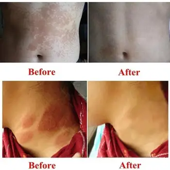 1pcs Eczema Ointment Skin Problem Treatments Psoriasis Pruritus Anti-Itching Cream Dermatitis Medical Plaster Herbal Balm
1pcs Eczema Ointment Skin Problem Treatments Psoriasis Pruritus Anti-Itching Cream Dermatitis Medical Plaster Herbal Balm