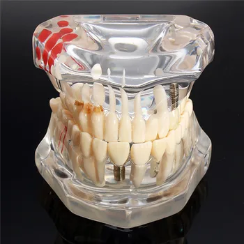 Dental Disease Teeth Model With Restoration Bridge Tooth Dentist For Medical Science Dental Teaching Model Teaching Study
Dental Disease Teeth Model With Restoration Bridge Tooth Dentist For Medical Science Dental Teaching Model Teaching Study