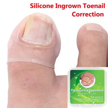 1Pair Silicone Ingrown Toenail Correction Tool Invisible Ingrown Toe Nail Treatment Elastic Straightening Clip Brace For Process
1Pair Silicone Ingrown Toenail Correction Tool Invisible Ingrown Toe Nail Treatment Elastic Straightening Clip Brace For Process