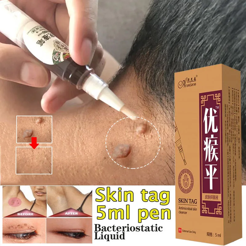 Moles & Genital Warts fast Removal Skin Tag Remover Medical Genital Wart Treatment Anti Foot Corn Against Bacteriostatic Liquid
Moles & Genital Warts fast Removal Skin Tag Remover Medical Genital Wart Treatment Anti Foot Corn Against Bacteriostatic Liquid