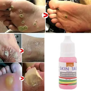 10ml Body Warts Treatment Cream Foot Corn Removal Remove Warts Care Plantar Body Warts Foot Cream And Ointment Genital Acne Z4H9
10ml Body Warts Treatment Cream Foot Corn Removal Remove Warts Care Plantar Body Warts Foot Cream And Ointment Genital Acne Z4H9