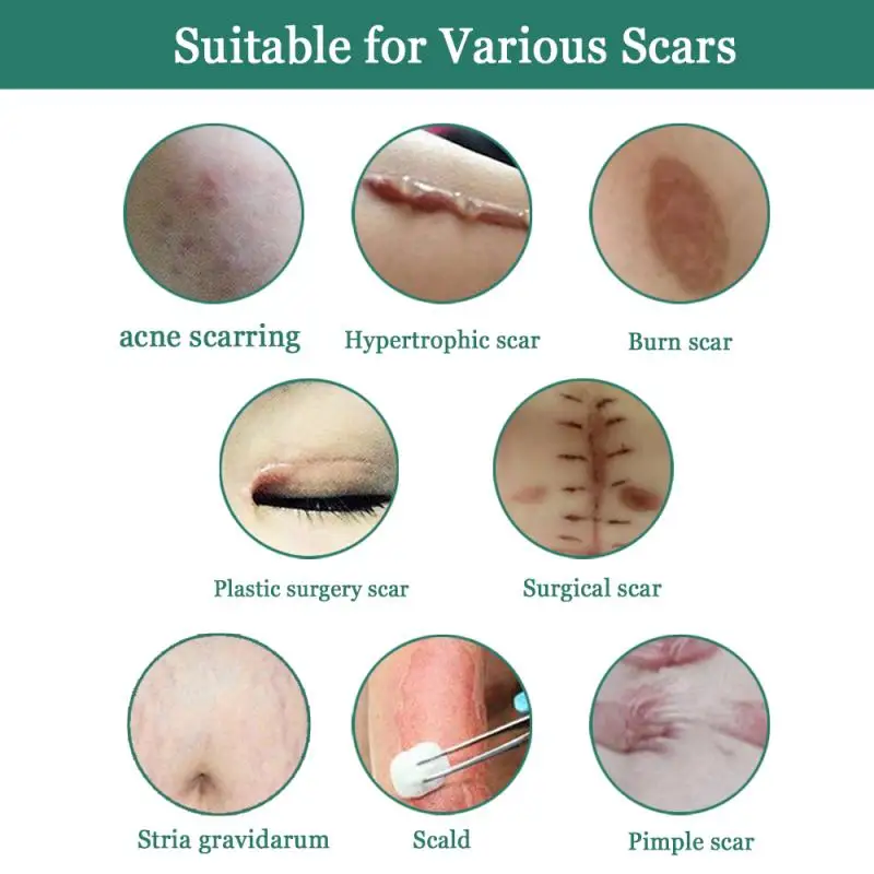 eelhoe scar removal cream