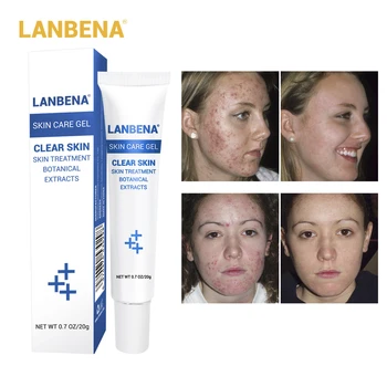 LANBENA Acne Treatment Gel Acne Cleaning Cream Blackhead Remover Acne Spots Face Acne Care Repair Comedone Pimple Scars Skin
LANBENA Acne Treatment Gel Acne Cleaning Cream Blackhead Remover Acne Spots Face Acne Care Repair Comedone Pimple Scars Skin