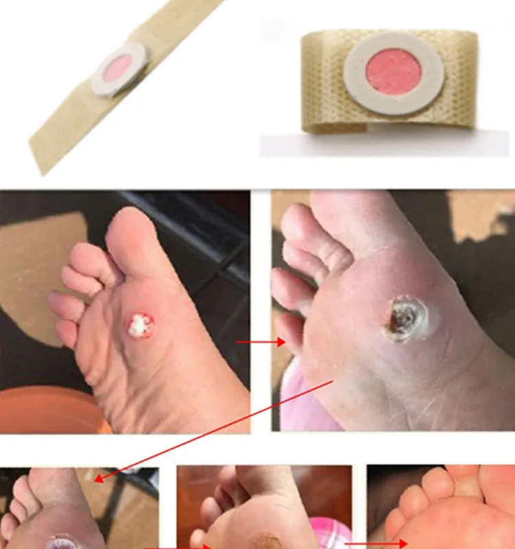 Foot Corn Killer Calluses Plantar Warts Thorn Pain Relief Plaster Foot Care Tool Medical Sticker Toe Protector Chicken Eye Patch
Foot Corn Killer Calluses Plantar Warts Thorn Pain Relief Plaster Foot Care Tool Medical Sticker Toe Protector Chicken Eye Patch