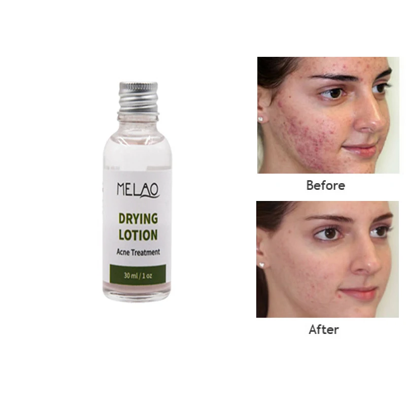 acne lotion for acne