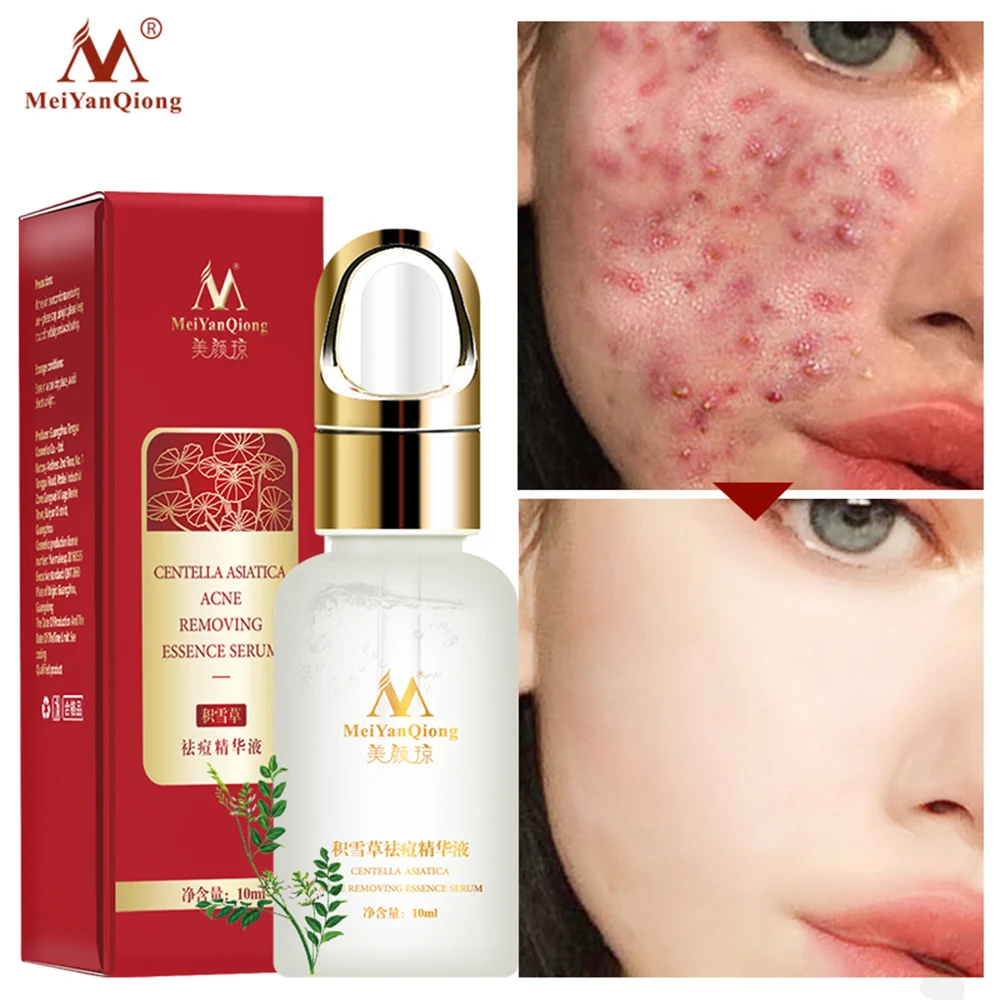 Centella Asiatica Acne Removing Essence Serum Remove Acne To Eliminate Acne Marks And Control Oil To Enhance Whiten Skin
Centella Asiatica Acne Removing Essence Serum Remove Acne To Eliminate Acne Marks And Control Oil To Enhance Whiten Skin