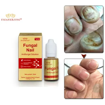 Fungal Nail Treatment Feet Care Essence Nail Foot Whitening Toe Nail Fungus Removal Gel Anti Infection Paronychia Onychomycosis
Fungal Nail Treatment Feet Care Essence Nail Foot Whitening Toe Nail Fungus Removal Gel Anti Infection Paronychia Onychomycosis