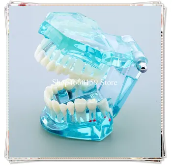Mariland bridge teeth Model M2001/Veneer fixed bridge Dental Model/DentalRestoration Model with post and core crown
Mariland bridge teeth Model M2001/Veneer fixed bridge Dental Model/DentalRestoration Model with post and core crown