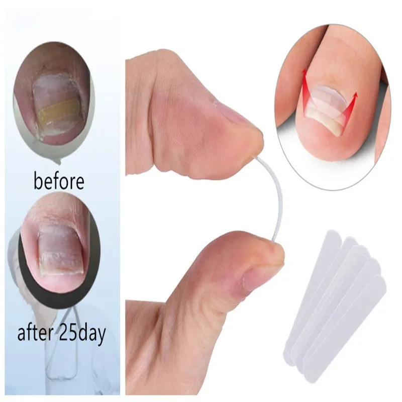10pcs Ingrown Toenail Correction Tool Ingrown Toe Nail Treatment Elastic Patch Sticker Straightening Clip Brace Pedicure Tool
10pcs Ingrown Toenail Correction Tool Ingrown Toe Nail Treatment Elastic Patch Sticker Straightening Clip Brace Pedicure Tool