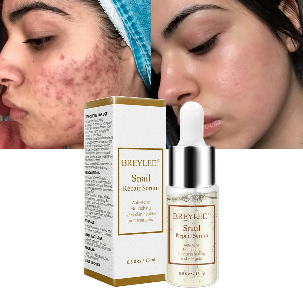 BREYLEE Snail Repairing Serum Anti-Acne Rejuvenation Essence Scars Acne Treatment Liquid Nourishing Moisturizing Face Skin Care
BREYLEE Snail Repairing Serum Anti-Acne Rejuvenation Essence Scars Acne Treatment Liquid Nourishing Moisturizing Face Skin Care