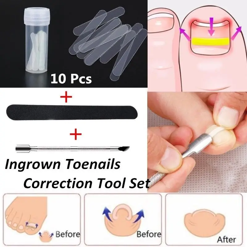 1 Set Ingrown Toe Nail Recover Correction Patch Pedicure Toenail Fixer Foot Care Tool
1 Set Ingrown Toe Nail Recover Correction Patch Pedicure Toenail Fixer Foot Care Tool