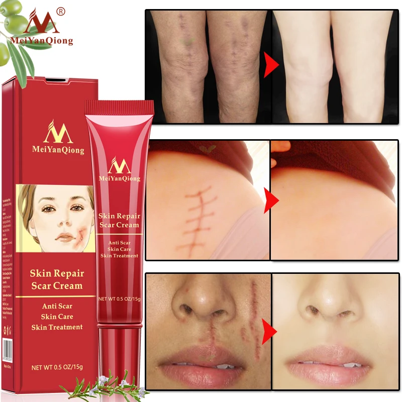 Acne Scar Removal Cream Skin Repair Face Cream Acne Spots Acne Treatment Blackhead Whitening Cream Anti Scar Stretch Marks 15g
Acne Scar Removal Cream Skin Repair Face Cream Acne Spots Acne Treatment Blackhead Whitening Cream Anti Scar Stretch Marks 15g