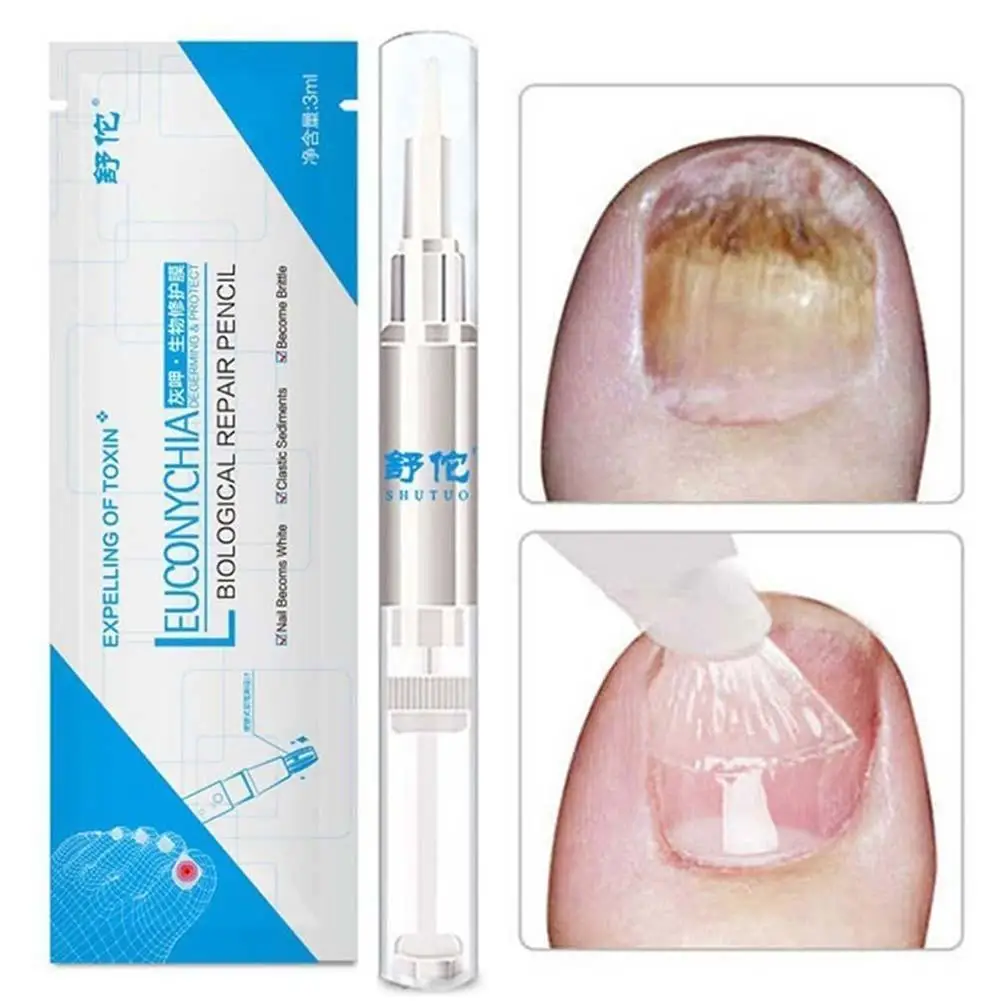 Anti Fungal Treatment Nail Pen Onychomycosis Paronychia Infection Herbal Toe Finger Nails Health Nail Fungus Treatment Massage
Anti Fungal Treatment Nail Pen Onychomycosis Paronychia Infection Herbal Toe Finger Nails Health Nail Fungus Treatment Massage