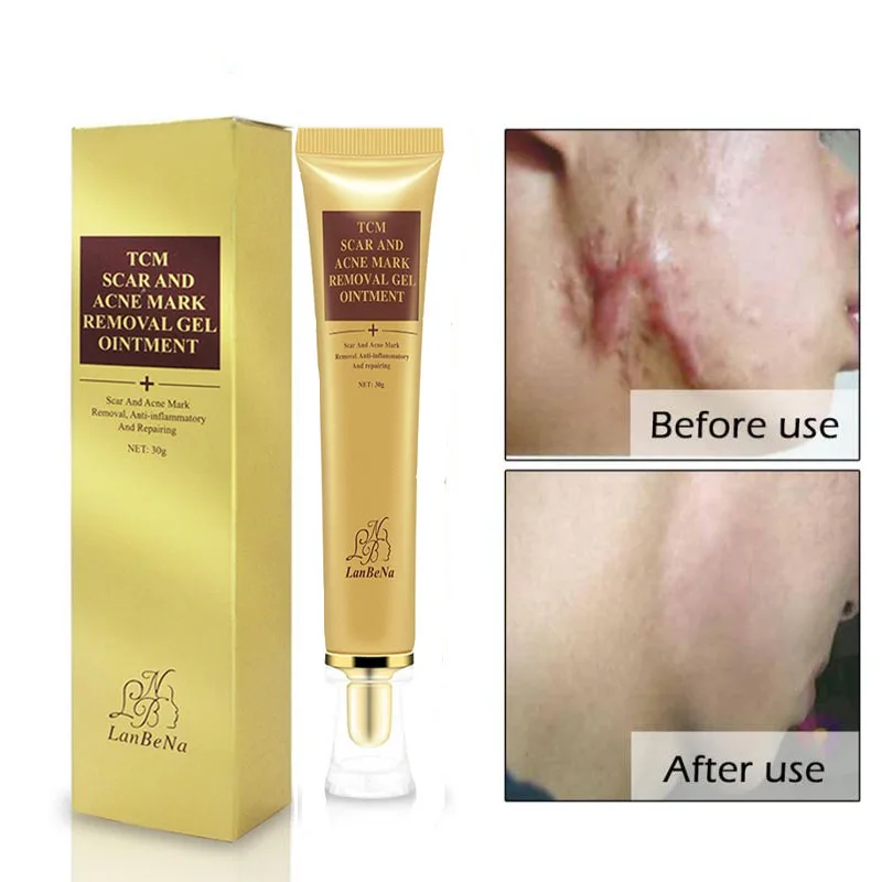 Remove Acne Scars Repair Gel Skin Care Red Spots Face Cream Stretch Marks pimple scars Moisturizing Acne Scar Cream
Remove Acne Scars Repair Gel Skin Care Red Spots Face Cream Stretch Marks pimple scars Moisturizing Acne Scar Cream