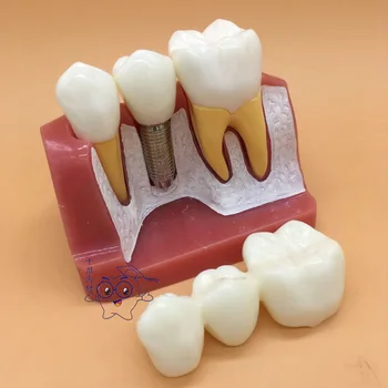 Dental Anatomical Model 4 Times Magnification Implanted Teeth Planting Nail Oral Teaching Anatomy Skeleton Model
Dental Anatomical Model 4 Times Magnification Implanted Teeth Planting Nail Oral Teaching Anatomy Skeleton Model