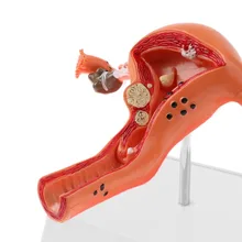 Model-Body Uterus Pathology Human Cross-Section Female Woman Ovary