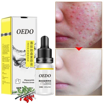 Acne Treatment Facial Serum Essence Anti Acne Scar Removal Cream Face Skin Care Whitening Pimple Remover For Acne Moisturizing
Acne Treatment Facial Serum Essence Anti Acne Scar Removal Cream Face Skin Care Whitening Pimple Remover For Acne Moisturizing