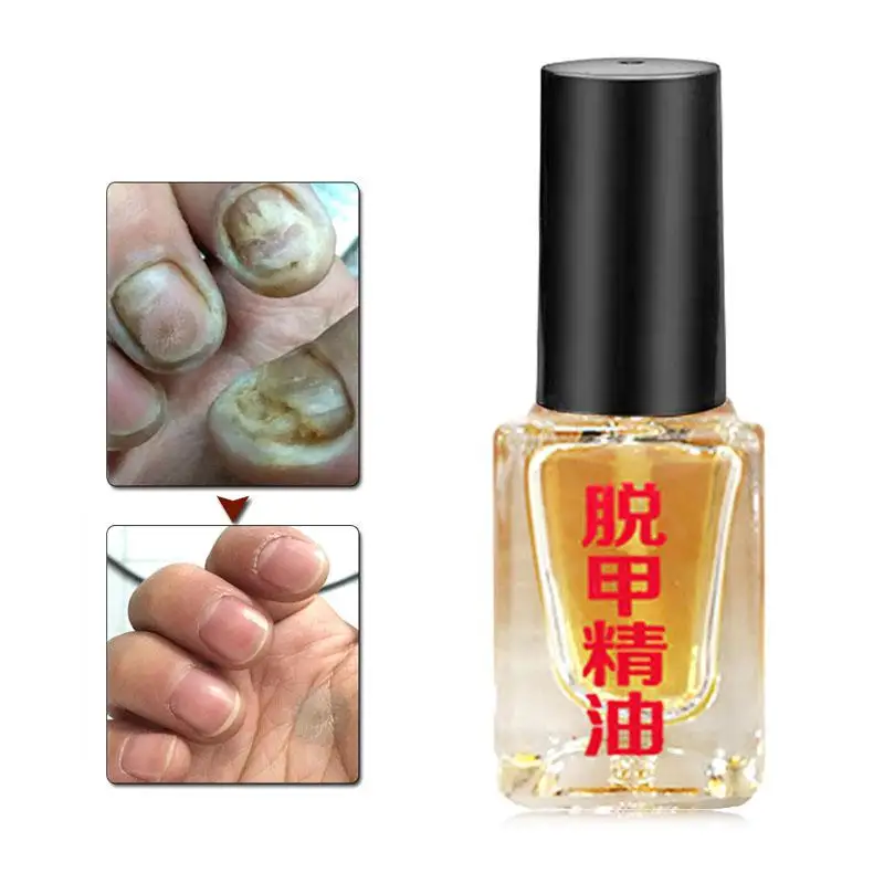 XY Fancy Nail Treatment Removal Onychomycosis Paronychia Essential Anti Bactericidal Nail Fungal Nail Infection Toe Treatment
XY Fancy Nail Treatment Removal Onychomycosis Paronychia Essential Anti Bactericidal Nail Fungal Nail Infection Toe Treatment
