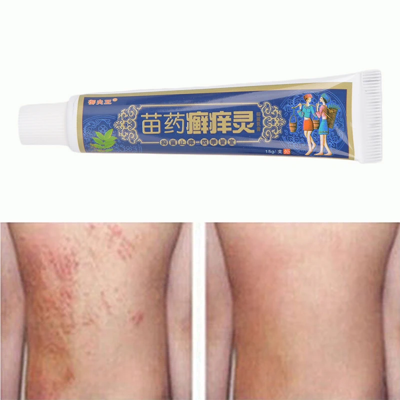 15g/Box Psoriasis Creams and Eczema Psoriasis Ointment Body Herbal Material Skin Care Health Products High Quality
15g/Box Psoriasis Creams and Eczema Psoriasis Ointment Body Herbal Material Skin Care Health Products High Quality