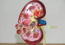 Kidney disease Anatomical Model Urology Medical Teaching model 21*18*14CM free shipping
Kidney disease Anatomical Model Urology Medical Teaching model 21*18*14CM free shipping