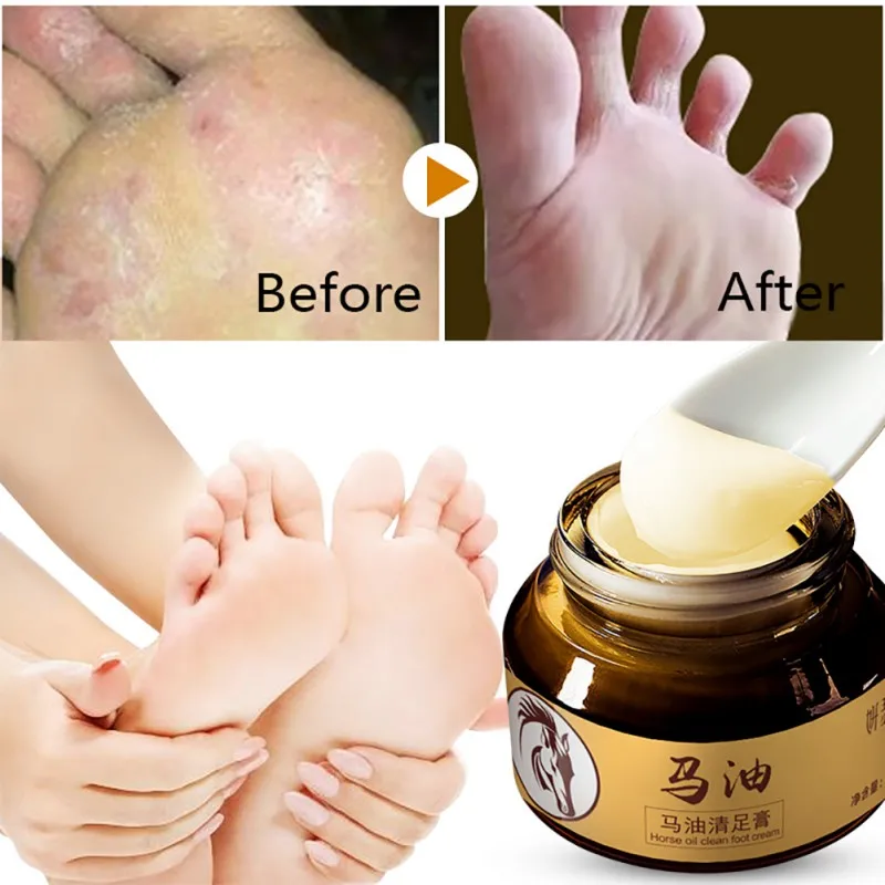 

Hand Foot Crack Repair Cream Feet Itch Blisters Anti-chapping Peeling Beriberi Bad Feet Ointment Foot Care Horse Oil Essence