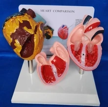 Medical Science Smoking heart and normal heart comparison model Human heart model Medical teaching models free shipping
Medical Science Smoking heart and normal heart comparison model Human heart model Medical teaching models free shipping