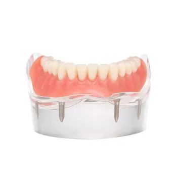 Dental Implant Teeth Model Removable Interior Mandibular Lower Jaw Teeth Model with 4 Implant screw Teaching Study Repair Model
Dental Implant Teeth Model Removable Interior Mandibular Lower Jaw Teeth Model with 4 Implant screw Teaching Study Repair Model