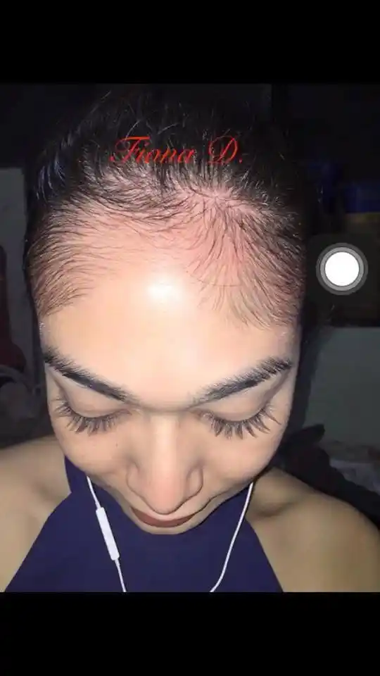 Ginseng Extract Forehead Regrow Hairline Grow Facial Hair Growth