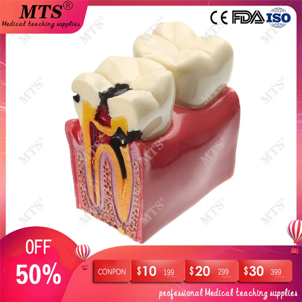 6 times Denture Teeth Model molar tooth contrast model Tooth Decay oral Dentist Pathologies teaching equipment
6 times Denture Teeth Model molar tooth contrast model Tooth Decay oral Dentist Pathologies teaching equipment
