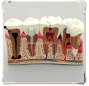 Dental teeth common pathologies model teaching model Tooth Dentist for teaching Dental Implant
Dental teeth common pathologies model teaching model Tooth Dentist for teaching Dental Implant
