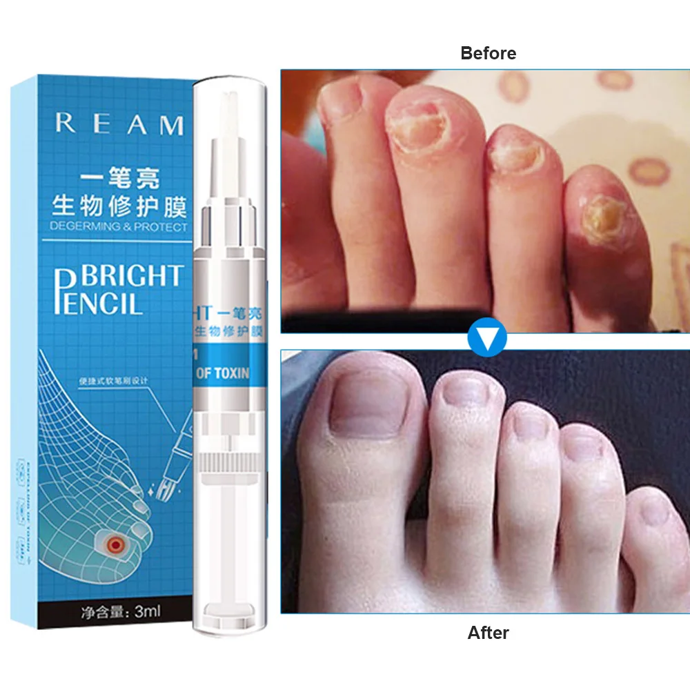 Nail Oil Treatment Fungus Restore Cuticle Stop Anti-Fungal Safe and Effective Against Nail Fungus Solution for Nail Care
Nail Oil Treatment Fungus Restore Cuticle Stop Anti-Fungal Safe and Effective Against Nail Fungus Solution for Nail Care