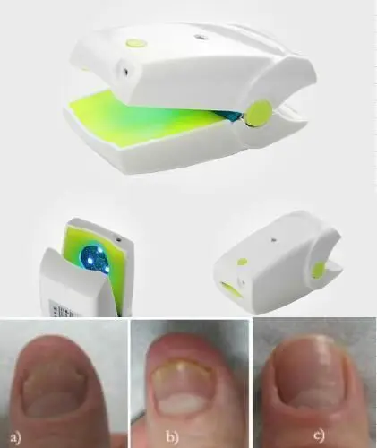 ToeNail Fungus Treat Nail Fungal Laser Device cure Nail fungus Onychomycosis Remover No side effect
ToeNail Fungus Treat Nail Fungal Laser Device cure Nail fungus Onychomycosis Remover No side effect