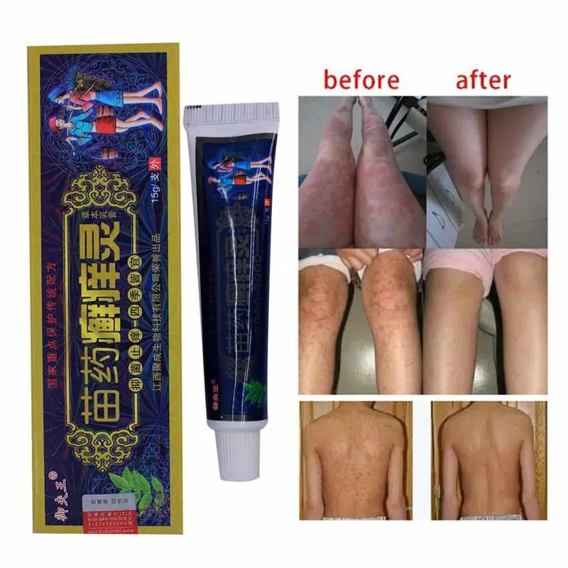 1PC Bacteriostasis Ointment for Anti-inflammatory Psoriasis Dermatitis and Eczema Massage Cream
1PC Bacteriostasis Ointment for Anti-inflammatory Psoriasis Dermatitis and Eczema Massage Cream