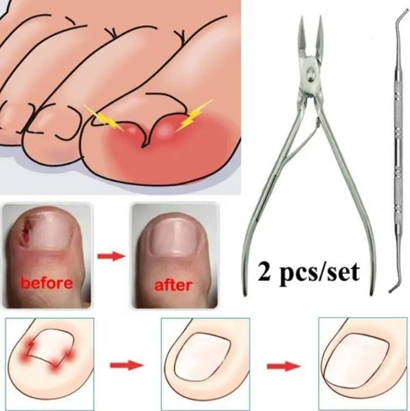 Pedicure tools professional ingrown Toe Nail Correction Nippers Clipper Cutter Dead Skin Dirt Remover + Paronychia Pedicure
Pedicure tools professional ingrown Toe Nail Correction Nippers Clipper Cutter Dead Skin Dirt Remover + Paronychia Pedicure